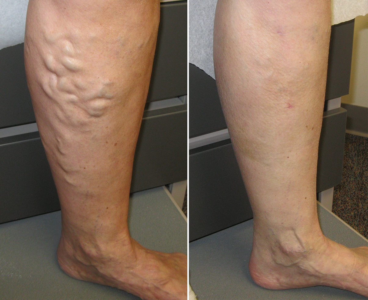 Resultado de imagen de Varicose Veins