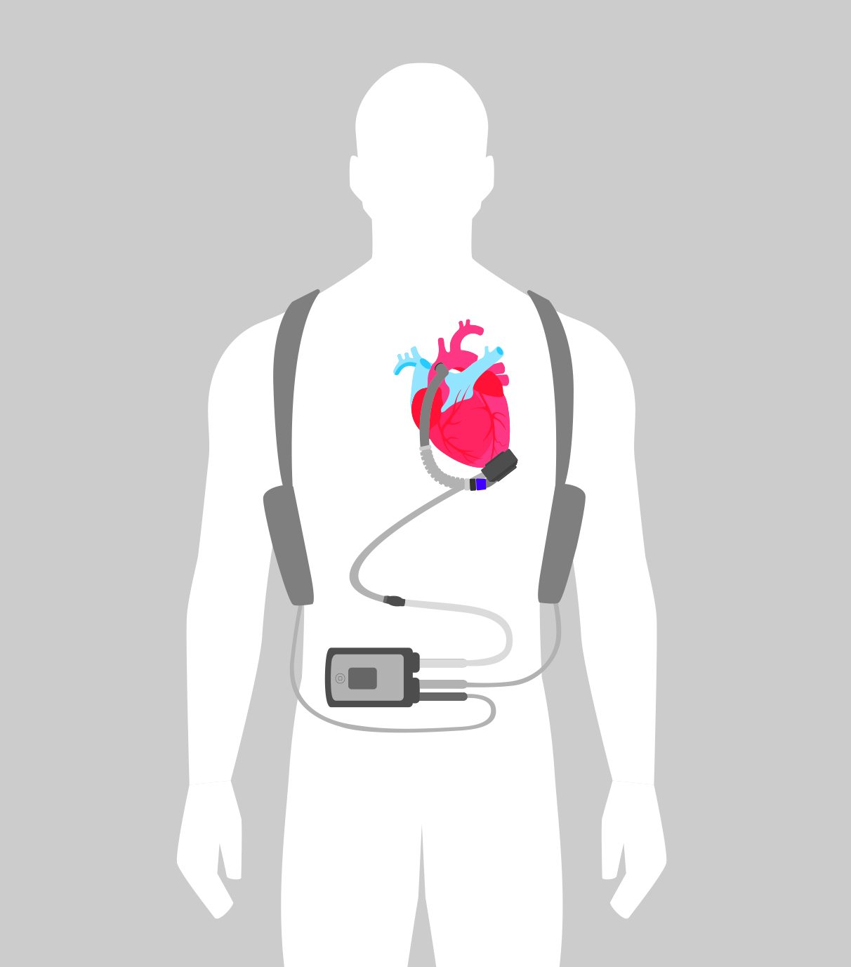 Helping hearts beat in innovative trial Department of Surgery