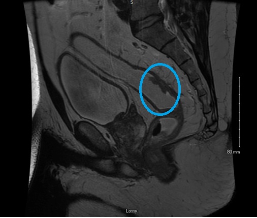 rectal polypectomy